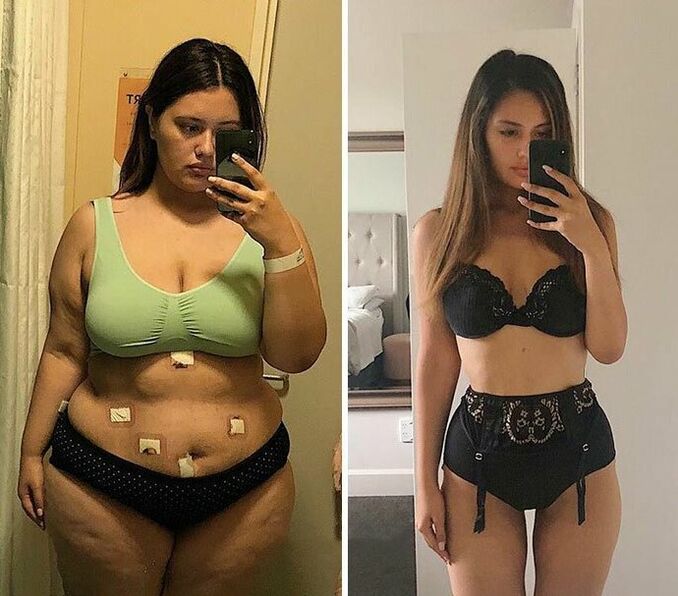 Cô gái trước và sau khi giảm cân với viên nang KETO Complete